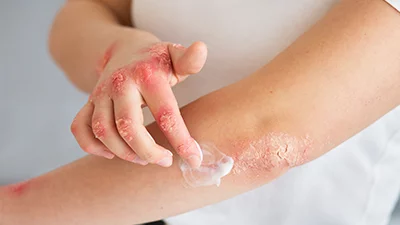 CCL_Zinc-Oxide-Antifungal-Benefits-for-Skin-Protection_thumbnail