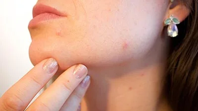 Zinc-Oxide-on-Acne-Prone-Skin---Effective-Treatment-&-Prevention - Citra CakraLogam