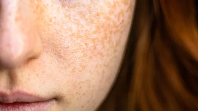 zinc oxide for melasma